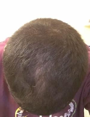 man after hair loss treatment with improved density at the crown