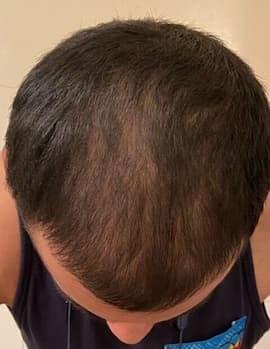 man before hair loss treatment with thinning at the crown