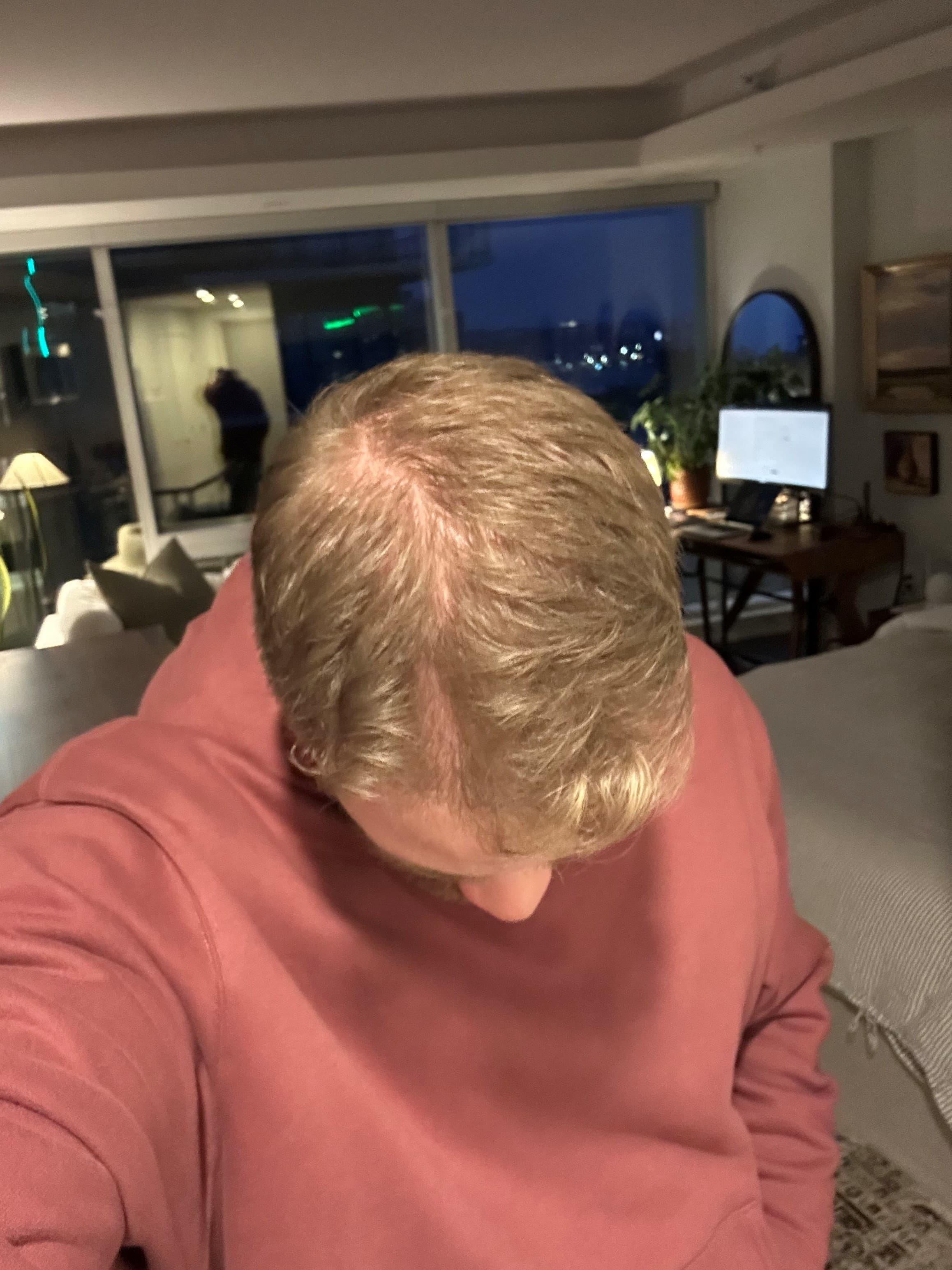 man after hair loss treatment with fuller hair and improved crown coverage, wearing a red hoodie