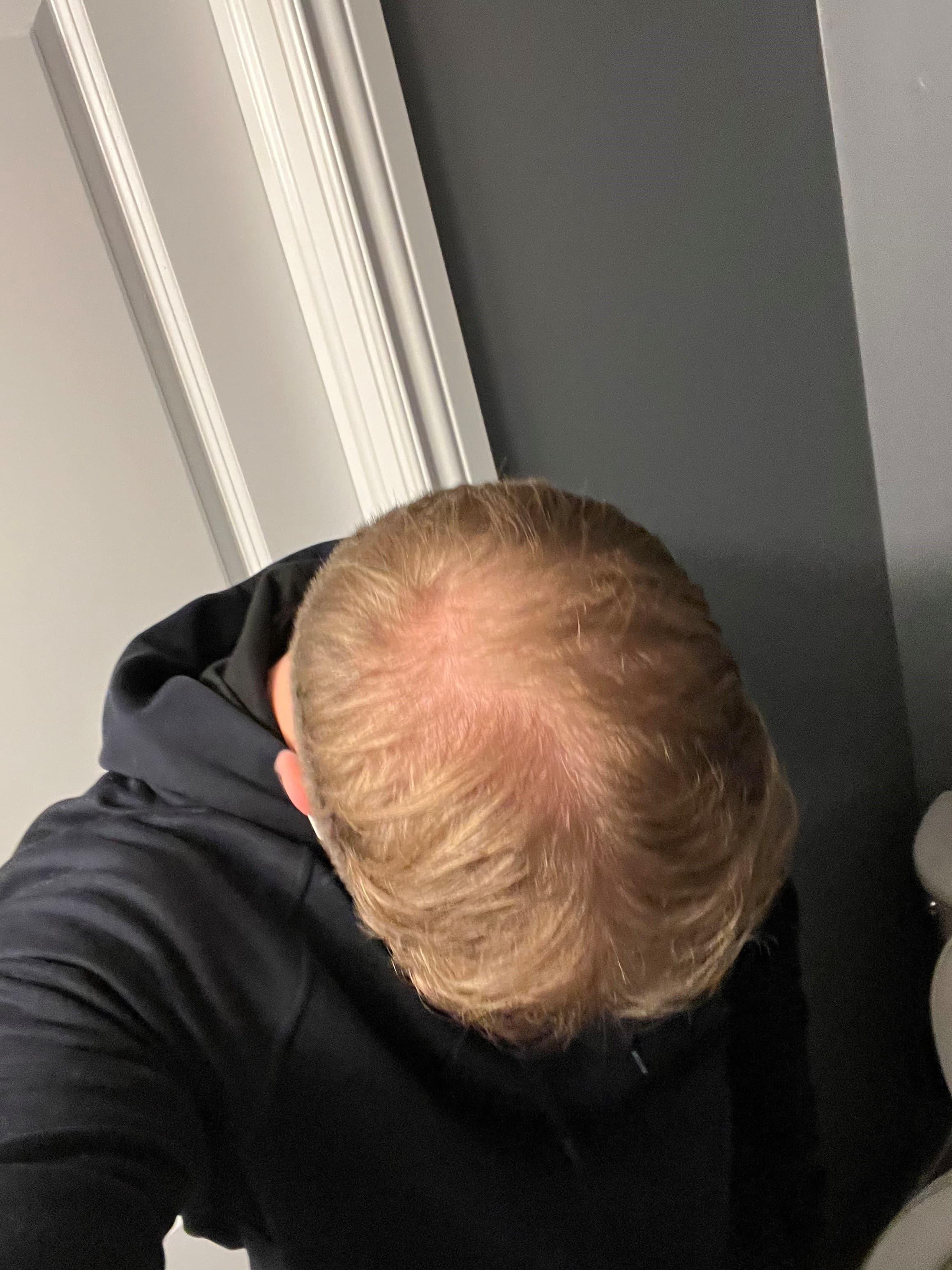 man before hair loss treatment with thinning crown and visible scalp, wearing a black hoodie