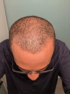 man before hair loss treatment with thinning hairline