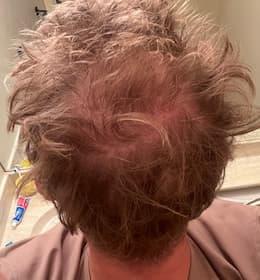 man after hair loss treatment with improved crown density