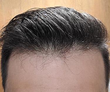 man after hair loss treatment with thinning hair