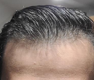 man before hair loss treatment with thinning hair