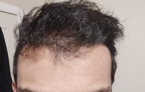 man before hair loss treatment with receding hairline