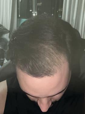 man after hair loss treatment with improved density at the crown and top