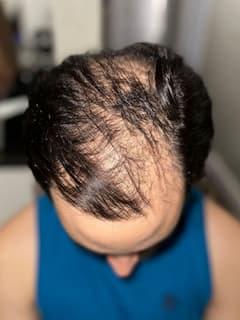 man before hair loss treatment with thinning at the crown and top of scalp