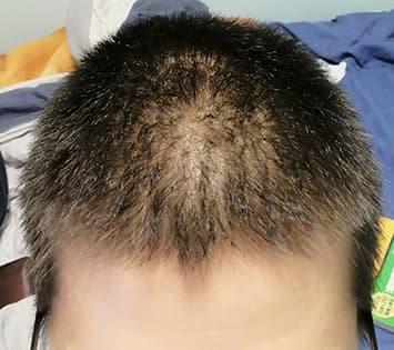 man before hair loss treatment with male pattern baldness