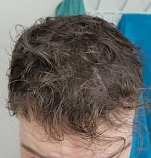 man after hair loss treatment with full hair at the crown