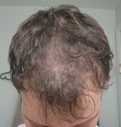 man before hair loss treatment with visible thinning at the crown