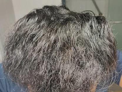 man using hair loss medication showing reduced hair loss