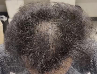 man before hair loss treatment with male pattern baldness