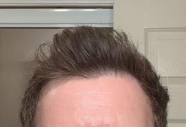 man after hair loss treatment with improved temples