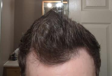 man before hair loss treatment with receding temples