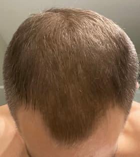 man after hair loss treatment with thinning hair