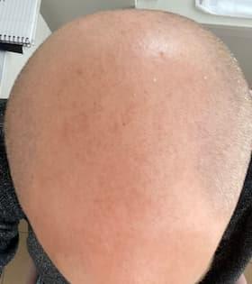 man before hair loss treatment with thinning hairline