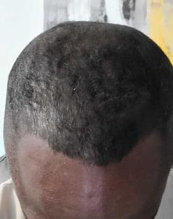 man using hair loss medication showing improved hairline