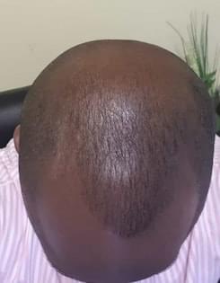 man before hair loss treatment with receding hairline