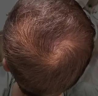 man before hair loss treatment with male pattern baldness